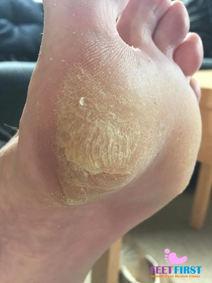 Feet first Mobile Foot Health Clinic®, Westonsupermare